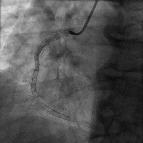 Occluded RCA Acute Stent Thrombosis